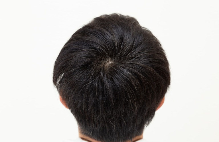 つむじをカバー | 大阪のヘアタトゥーならscalpsalon Dr.era