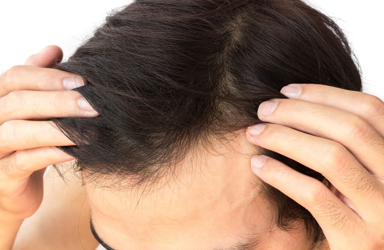 生え際をケア | 大阪のヘアタトゥーならscalpsalon Dr.era