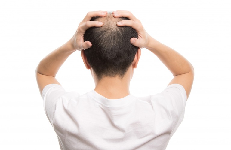 円形の脱毛症に対応 | 大阪のヘアタトゥーならscalpsalon Dr.era